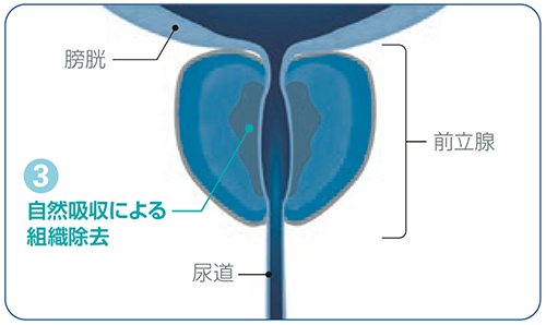 WAVE治療後の組織吸収