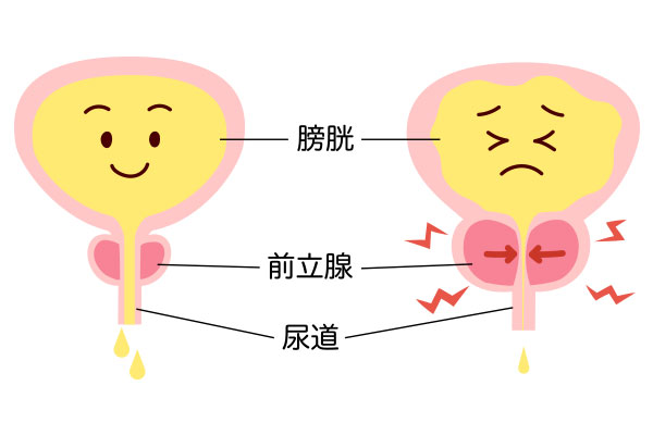 前立腺肥大症